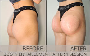 BEFORE AFTER BOOTY ENHANCEMENT  AFTER 1 SESSION