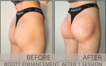 BEFORE AFTER BOOTY ENHANCEMENT  AFTER 1 SESSION