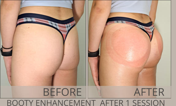 BEFORE AFTER BOOTY ENHANCEMENT  AFTER 1 SESSION