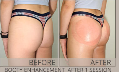 BEFORE AFTER BOOTY ENHANCEMENT  AFTER 1 SESSION