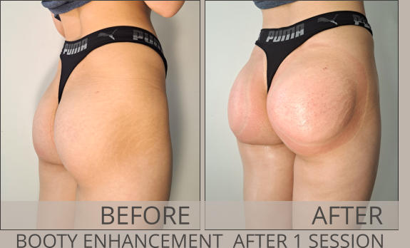 BEFORE AFTER BOOTY ENHANCEMENT  AFTER 1 SESSION